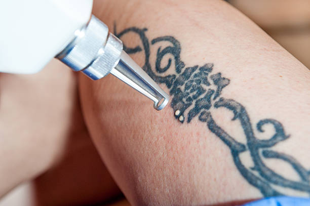 Удаление татуировок лазером