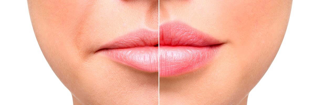 Коррекция и увеличение губ